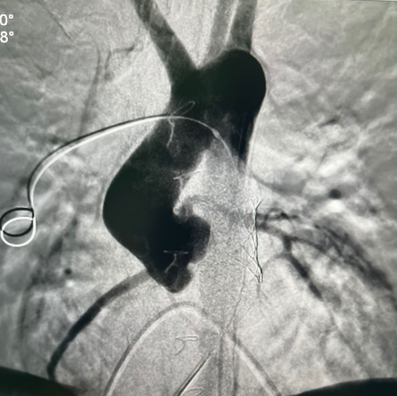Врачи Педиатрического университета выполнили рентгенэндоваскулярную имплантацию клапана лёгочной артерии 14-летнему пациенту из Луганска 3