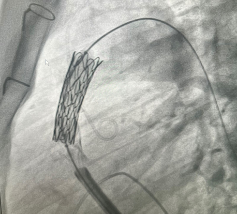 Врачи Педиатрического университета выполнили рентгенэндоваскулярную имплантацию клапана лёгочной артерии 14-летнему пациенту из Луганска 5