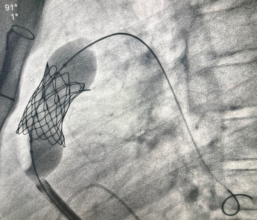 Врачи Педиатрического университета выполнили рентгенэндоваскулярную имплантацию клапана лёгочной артерии 14-летнему пациенту из Луганска 6