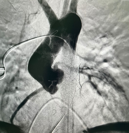 Врачи Педиатрического университета выполнили рентгенэндоваскулярную имплантацию клапана лёгочной артерии 14-летнему пациенту из Луганска 7