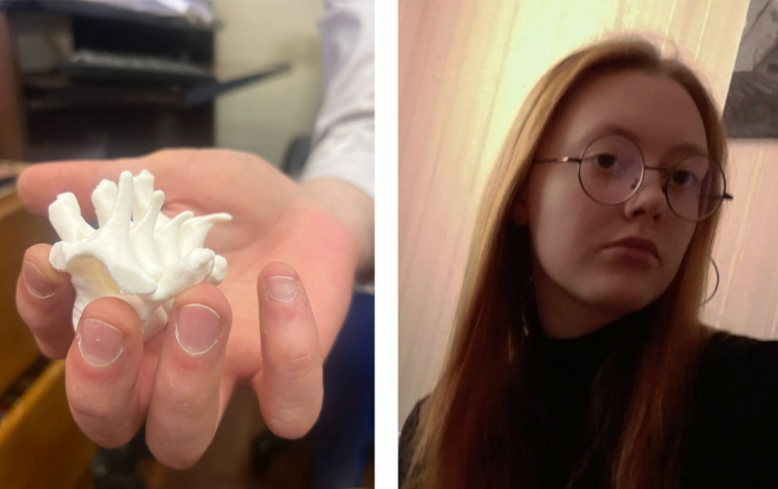 Врачи Педиатрического университета провели операцию по коррекции сколиоза пациентке из Петропавловска-Камчатского с трансплантированной почкой