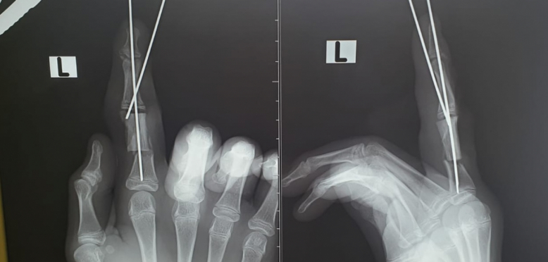 Врачи Педиатрического университета сохранили подростку палец, поврежденный шлифовальной машиной